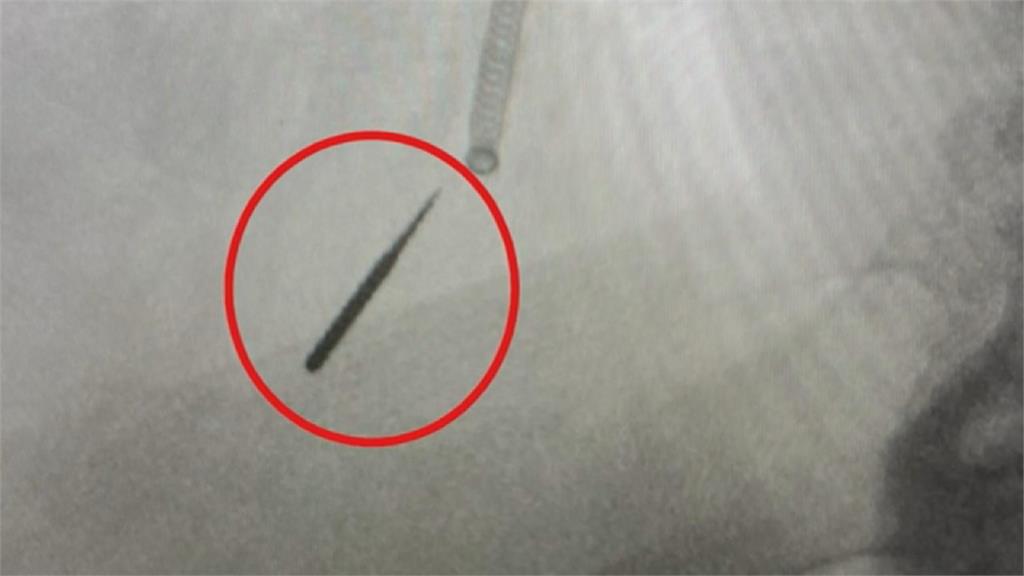 美國男補牙竟將鑽針「吸進肺」 胸腔醫支氣管鏡解危
