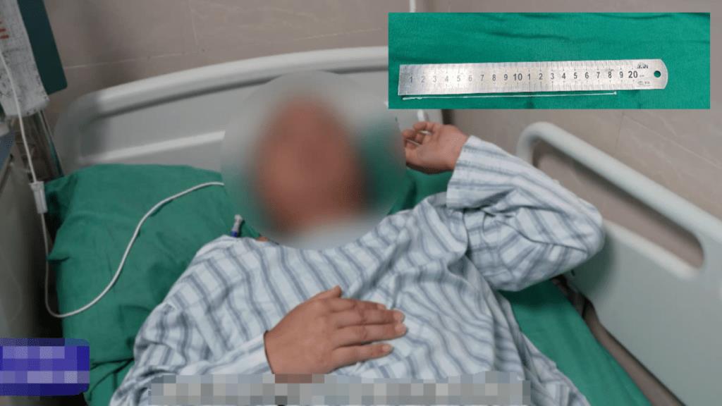 中國男想護眼吞蛇膽⋯一看「眼前全上馬賽克」!竟從腦袋取出18公分寄生蟲