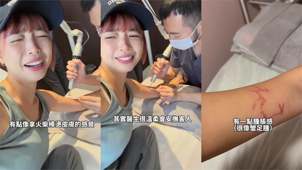 阿圓除刺青「像被火柴燒」痛到臉歪!遭網酸「何必當初?」不忍反擊了