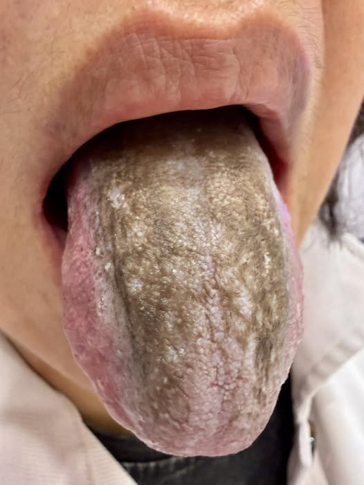 婦患牙周病「狂灌強效漱口水」　她「整根舌頭變灰色」醫示警快停下！