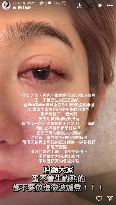 8點檔林志玲「微波爐煮雞蛋」爆炸!眼角膜破洞、皮膚燙傷「送醫慘況曝」