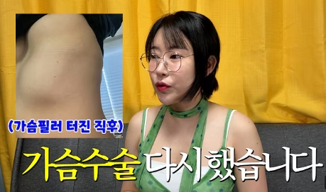 女星砸千萬隆乳慘變惡夢！填充物下垂到肋骨變「4個胸部」畫面首度公開
