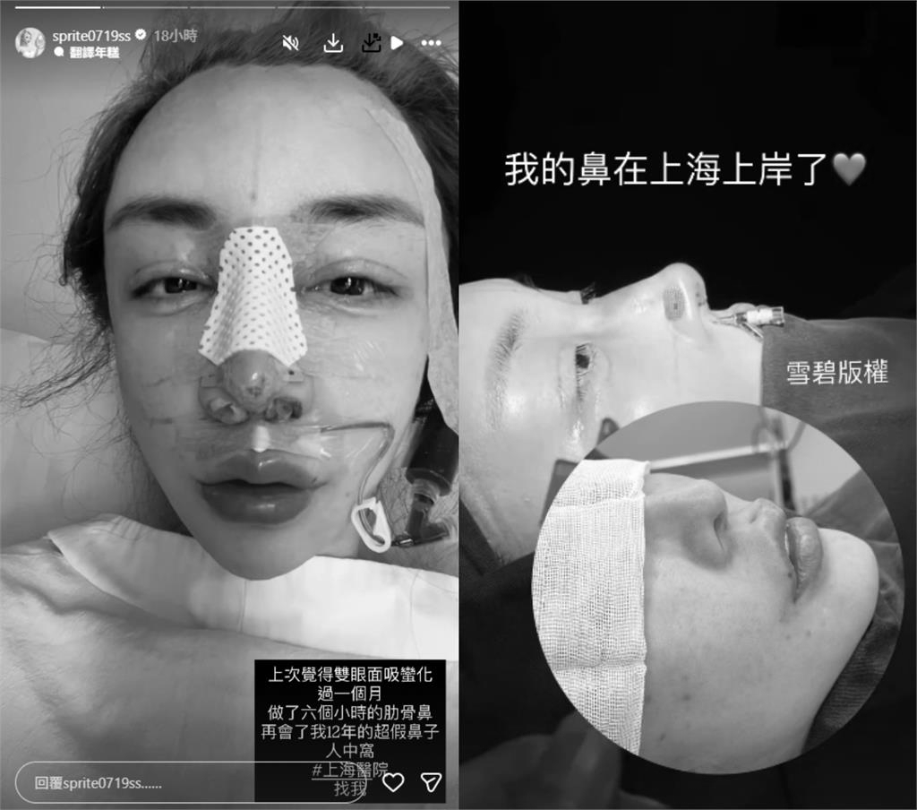 砸近千萬整型…雪碧又掰了「超假鼻子」！公開「術後拆線真面目」：還在腫
