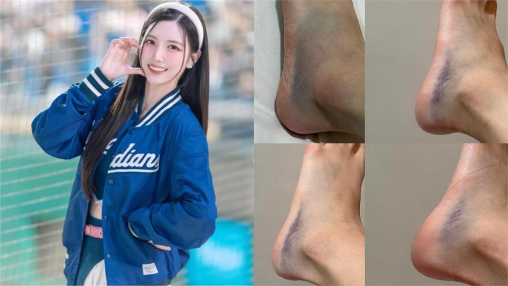南珉貞熱舞「慘扭腳踝」站不起！休養後PO「痛苦遮臉照」喊話粉絲這1句