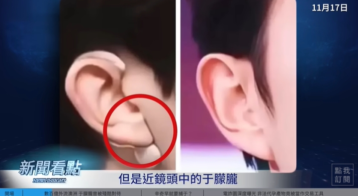 于朦朧遭爆「戴矽膠假耳」畫面曝！他曬右臉「辛」字烙印照：盼于粉出面