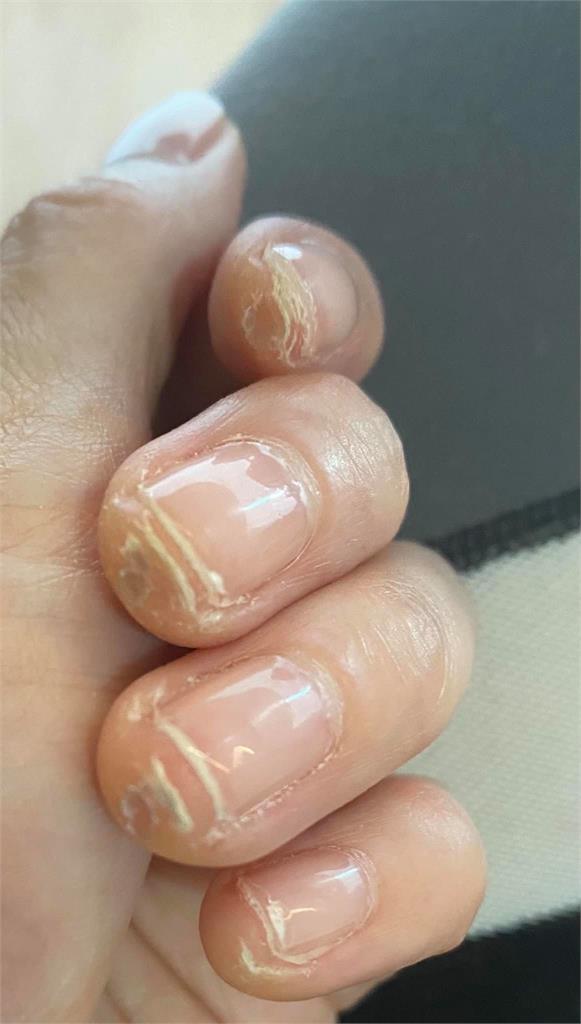 徐若瑄「狂練1件事」自曝成鋼鐵手指頭!小鮮肉慘遭戳傷:好痛