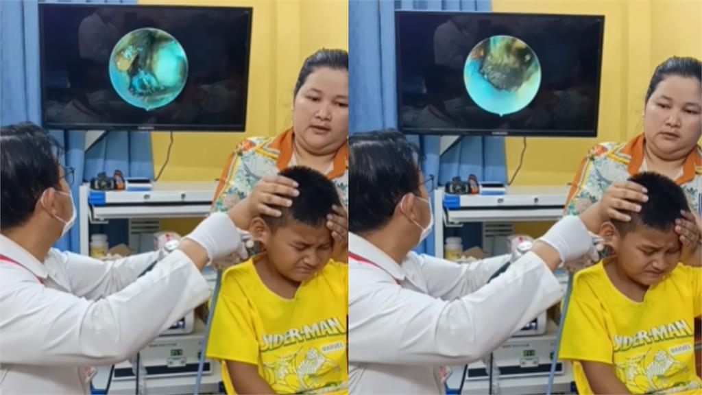 有影/柬埔寨男童喊耳痛 醫檢查驚見「活蟑螂瘋狂蠕動」駭人畫面流出