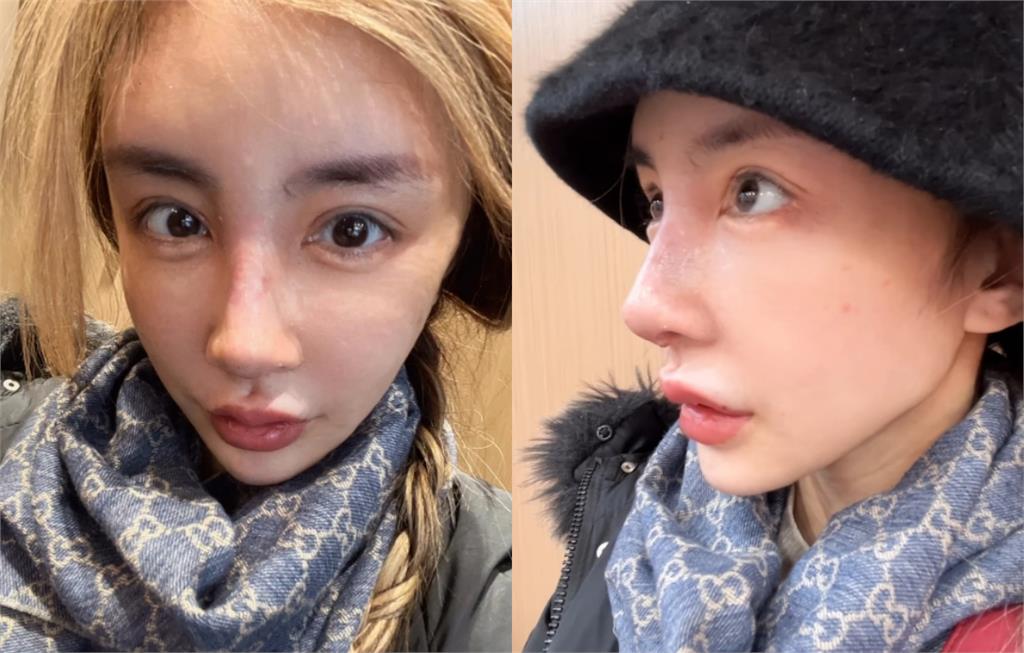 砸近千萬整型…雪碧又掰了「超假鼻子」！公開「術後拆線真面目」：還在腫