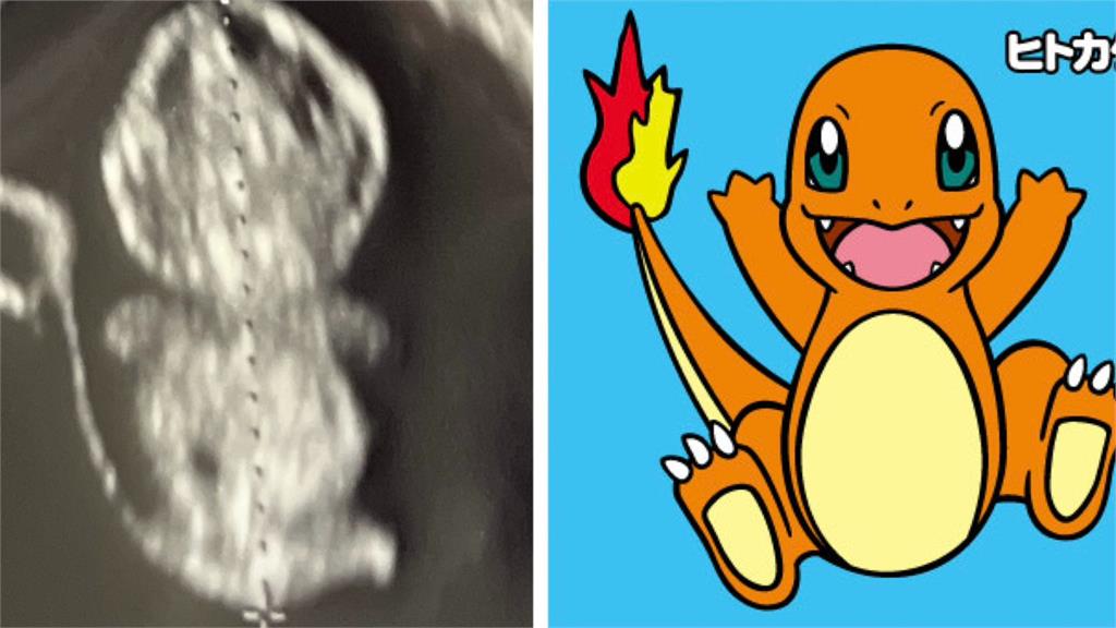 超音波產檢照驚見「小火龍」身影 寶可夢迷笑喊:孩子的媽是噴火龍吧!