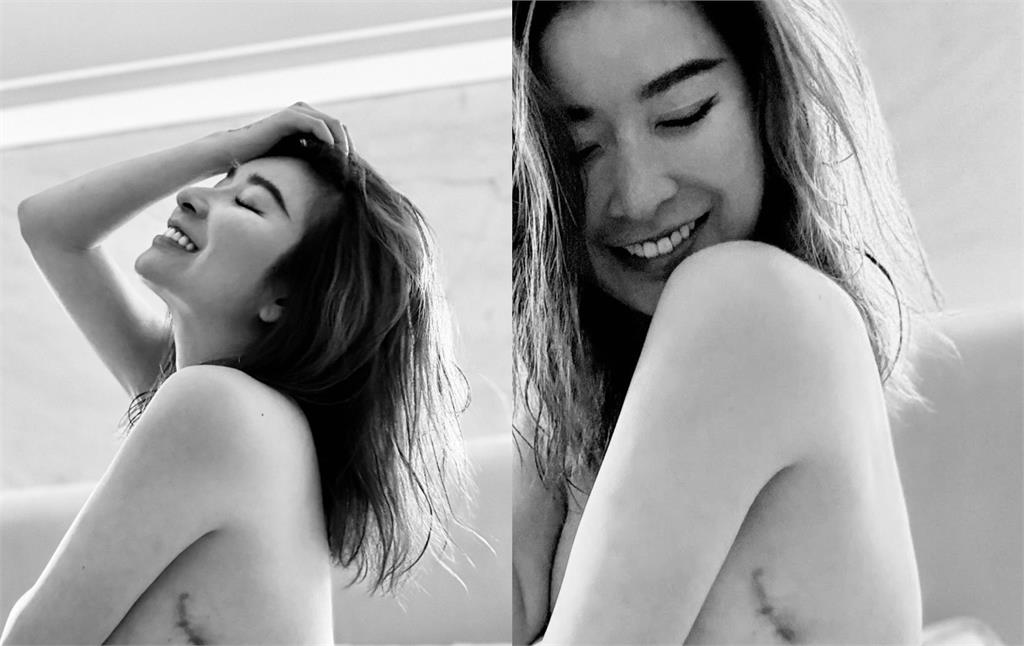 許維恩挺過乳癌首公開「雙乳切除傷疤」！上身淨空吐心聲：是人生的勳章