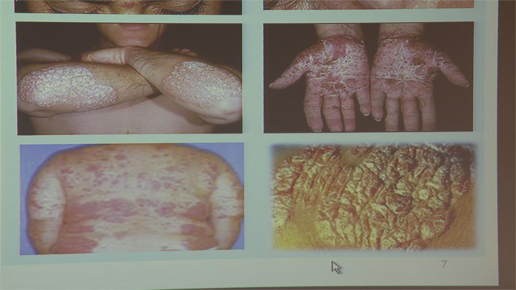 「糖尿病患者」罹患「帶狀疱疹」風險高　醫師：接種疫苗可預防