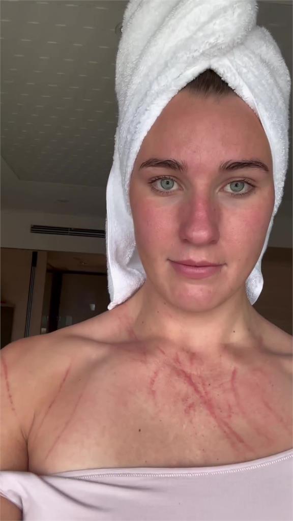 水球選手「胸口抓痕肆虐」傷勢曝光 　PO片譏諷：好喜歡跟中國比賽