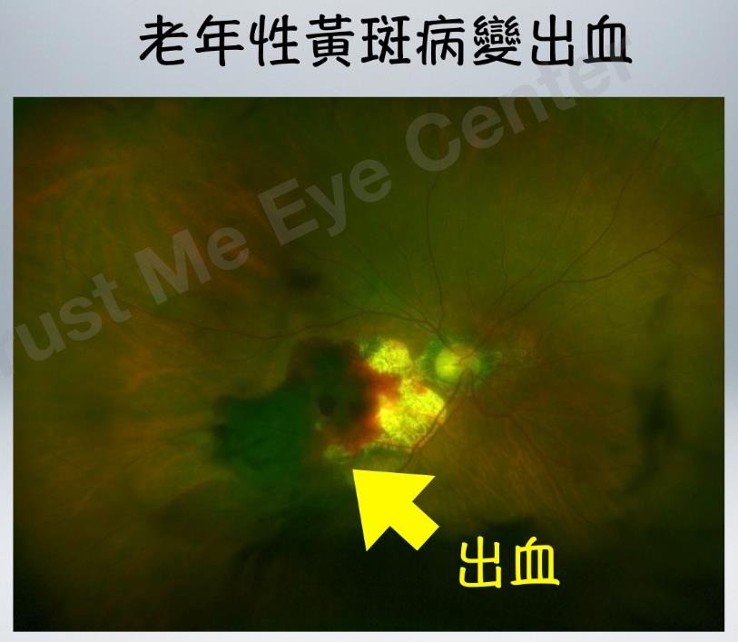 黃斑病變病情急轉直下!眼科醫師揭幕後元兇竟是「沒感覺」的高血壓