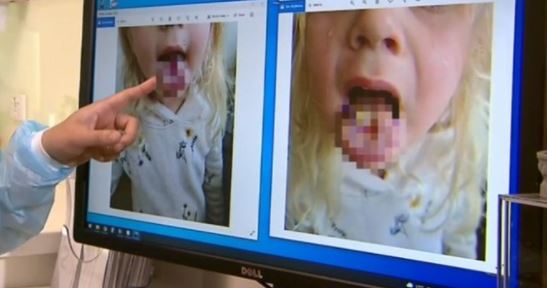 4歲女童吃「酸酸糖」舌頭灼傷破大洞！圖片超嚇人　醫：酸性比檸檬更強