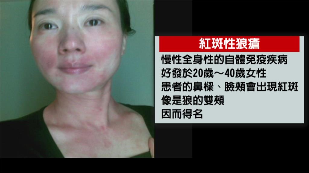 不只坣娜!港星周海媚也因罹患紅斑性狼瘡病逝