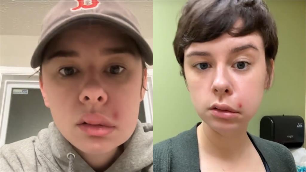 女網紅擠一顆痘痘竟「半臉癱瘓」！醫警告「這1處」最危險：死亡三角區