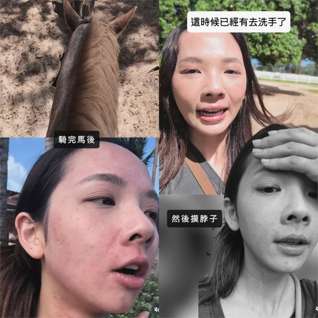 滴妹飛夏威夷做「1件事」大過敏!紅疹爬滿身「近距離爛臉照」嚇壞眾人