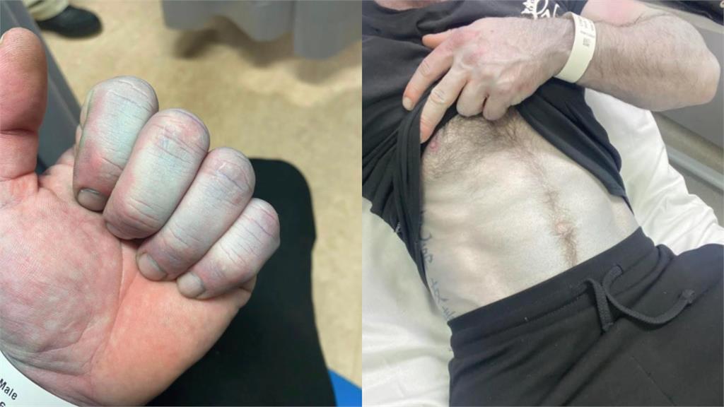 男裸睡醒來「全身變藍」送急診！超詭狀態流出「醫護全嚇壞」真相曝光