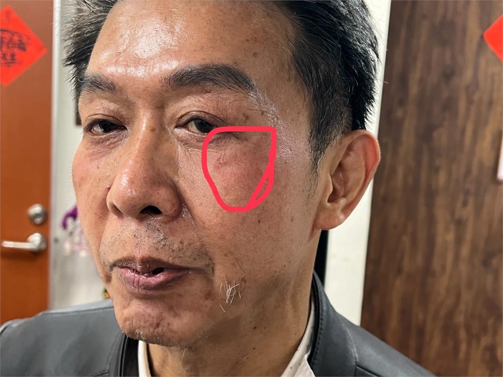 快新聞/傷勢曝光!選罷法肉搏戰 許智傑控遭邱鎮軍「壓頭4次」