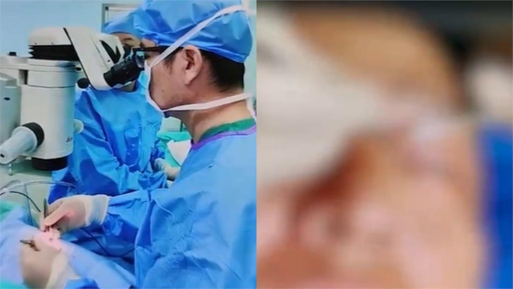 眼睛痛醫生檢查竟「挖出2.5cm原子筆頭」！他憶：27年前被同學戳過…