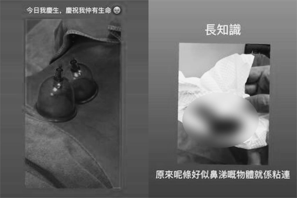 女星疑病倒曬「拔罐染血紙巾照」!昔窮到剩1000元嘆:慶祝我還有生命