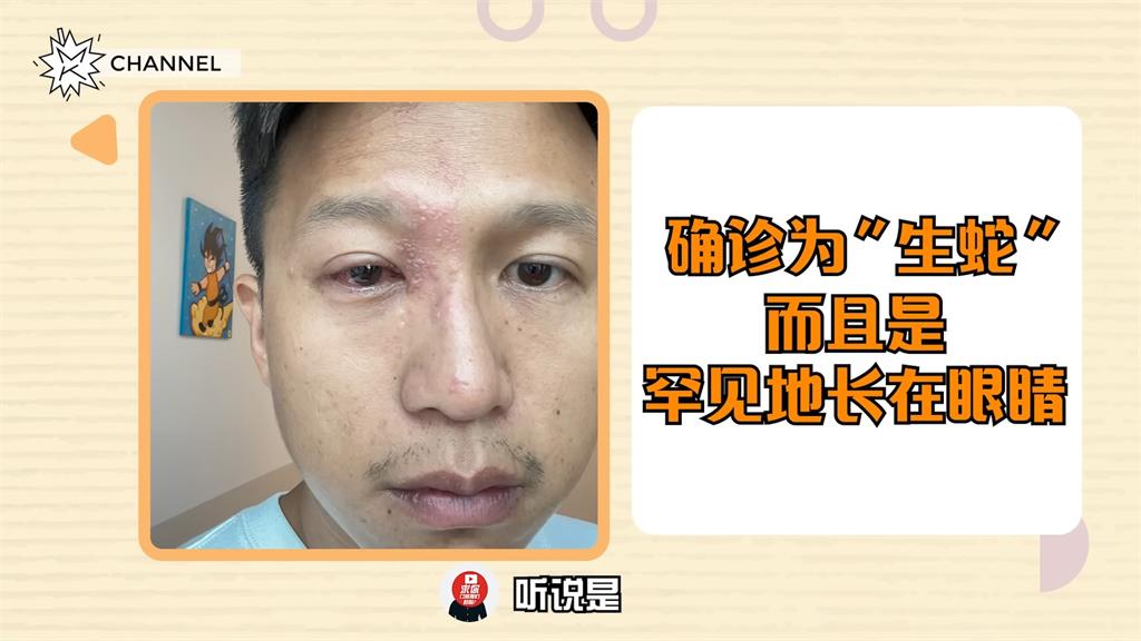 大馬網紅「右眼長皮蛇」失聯!視訊復出揭病情 整張臉毀容險失明