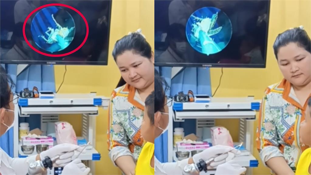 有影/柬埔寨男童喊耳痛 醫檢查驚見「活蟑螂瘋狂蠕動」駭人畫面流出