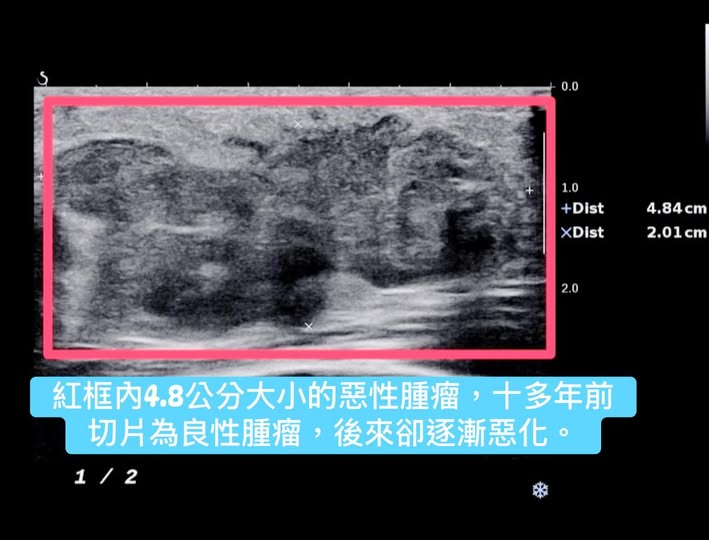 她高中切片良性多年後竟成「雞蛋大腫瘤」！醫示警「別輕忽快檢查」