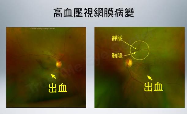 50歲婦人眼前「一片黑矇」竟揪出高血壓!醫揭眼睛是全身健康警示燈