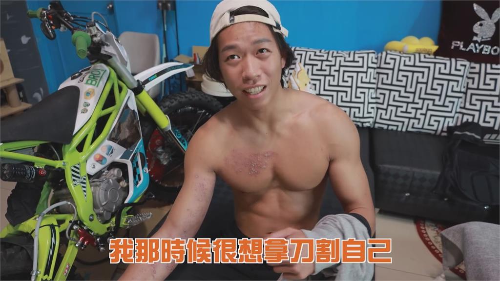 痛到骨子裡!台男確診後得皮蛇 形容「像被數萬隻蟲咬」:最想死的病