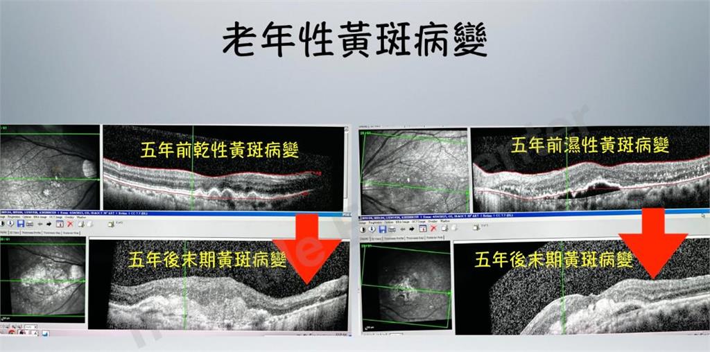 老年黃斑病誤認白內障?醫分享案例:老婆婆中斷治療最終錯失黃金期
