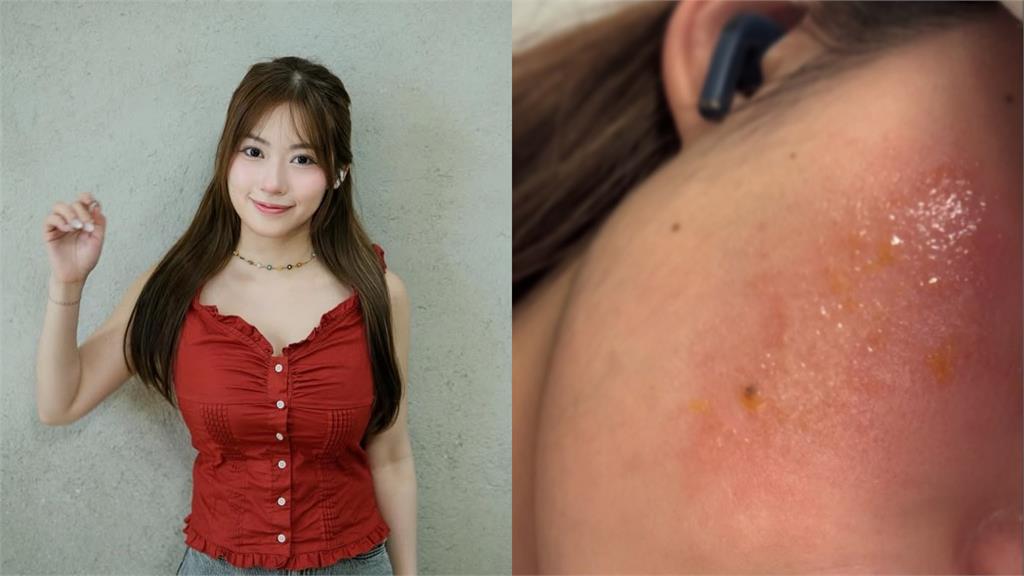 27歲甜美女星敷面膜「險毀容」 曝病情吐「250字心聲」:臉上像10級火災