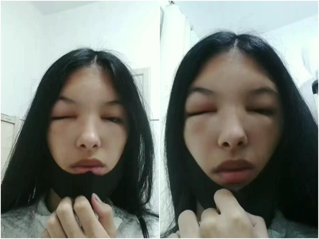 19歲女模染髮後變豬頭！「雙眼腫脹＋頭皮流湯」過敏超嚴重險毀容