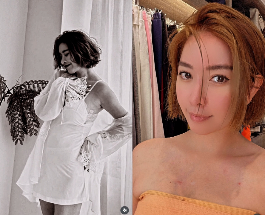 許維恩PO片「切除雙乳」抗乳癌過程！突喊「7月又要衝一波」網湧入關心