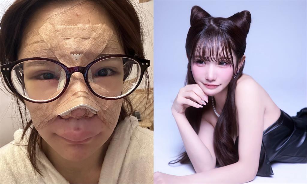 暴牙妹子「砸554萬全臉暴改」走紅！震撼宣布「參演Netflix」絕美近照被挖