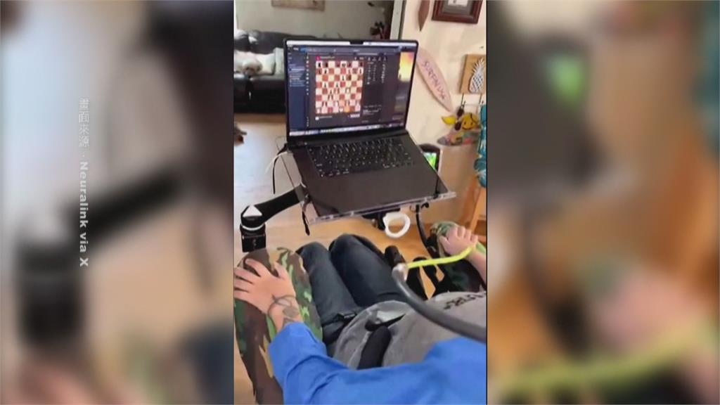 癱瘓患者康復見曙光！　首例腦部植入晶片患者可意念玩電腦遊戲