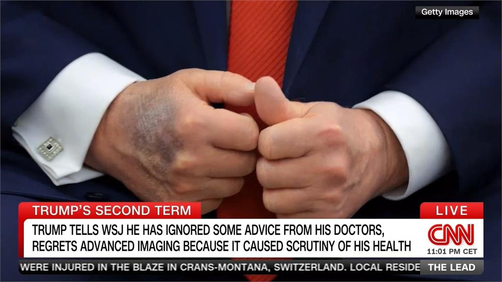 健康亮紅燈?手部驚見「神秘瘀青」 川普自曝每日大量服用阿斯匹靈