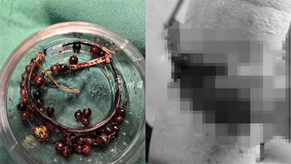 33歲女「手鐲戴10年」沒脫!因體型改變「嵌進肉裡」手腕潰爛畫面曝光