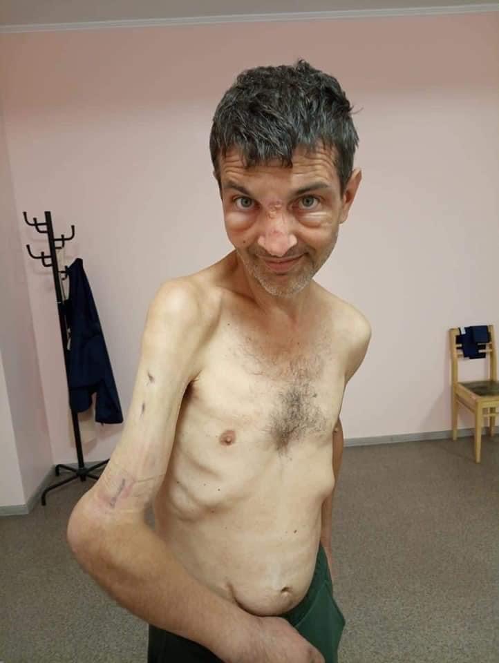 烏克蘭戰俘餓到變「皮包骨」！手畸形恐怖畫面曝「對比照超驚人」
