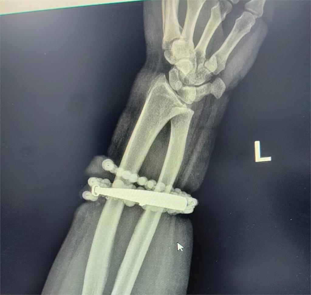 33歲女「手鐲戴10年」沒脫!因體型改變「嵌進肉裡」手腕潰爛畫面曝光